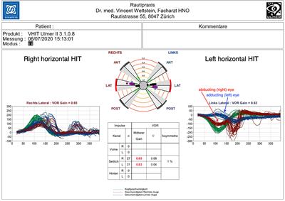 Case report: A disconjugate pattern in video head impulse testing hints toward a central cause of acute vertigo